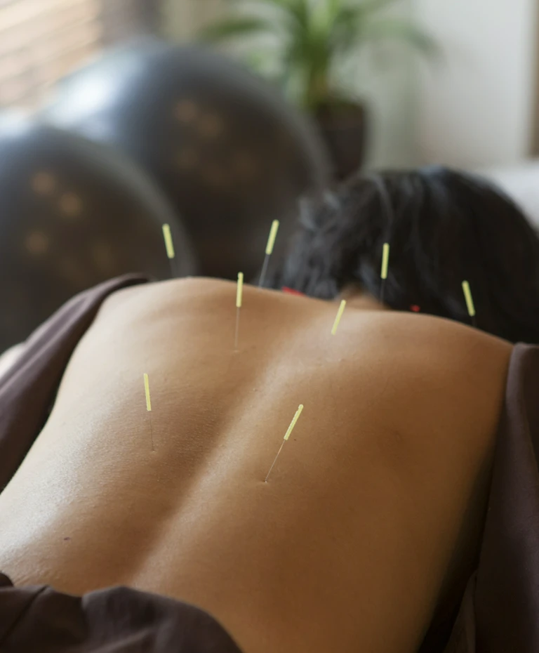 Akupunktura